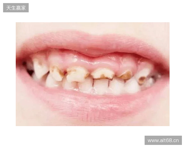 韦林顿确诊上唇部贯通伤;11、21牙半脱位;上颌前牙区牙槽骨骨折 韦林顿确诊上唇部贯通伤;11、21牙半脱位;上颌前牙区牙槽骨骨折